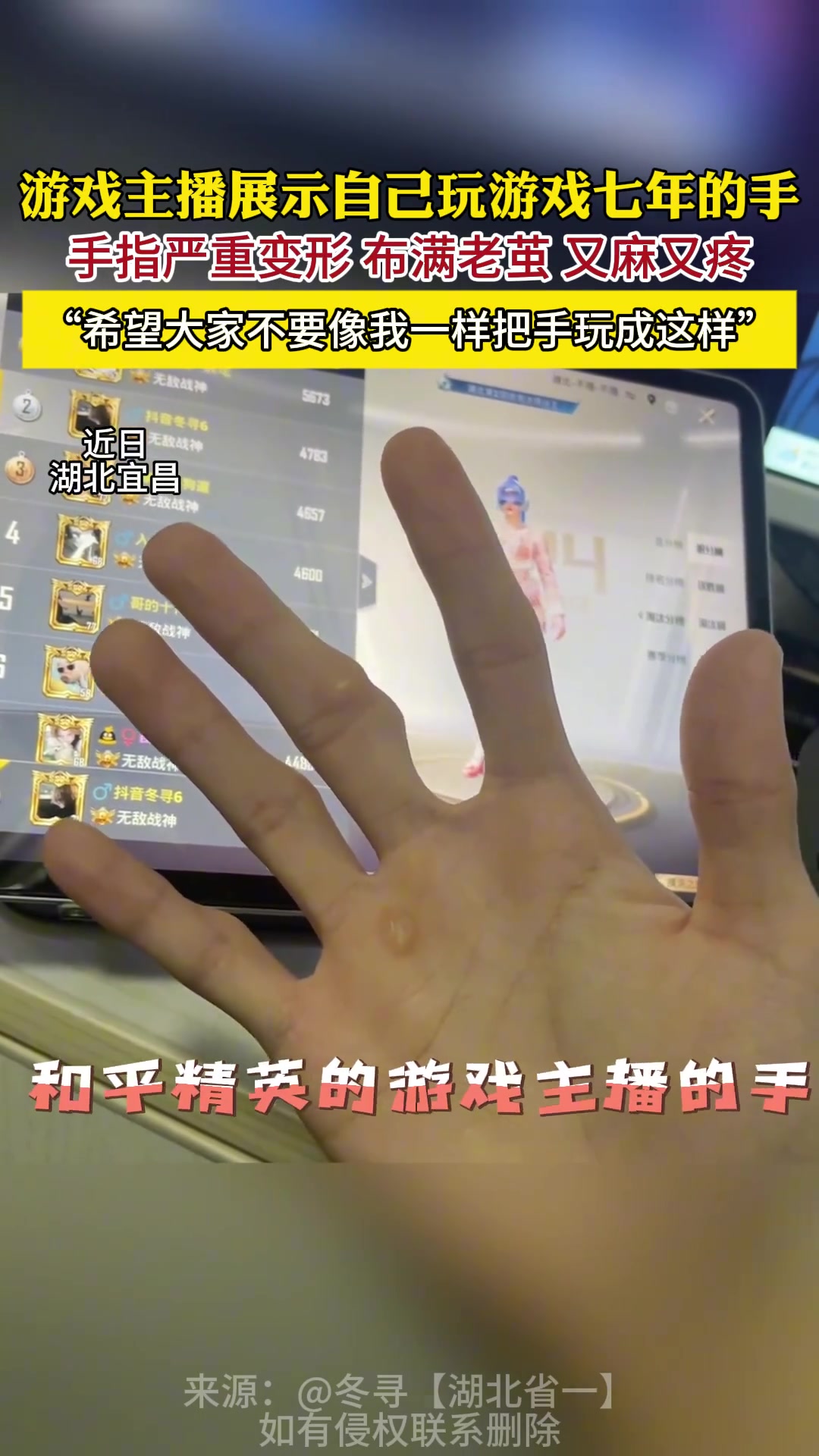 金年会金字招牌信誉至上游戏主播玩游戏7年手指严重变形：每天固定一个动作十几个小时